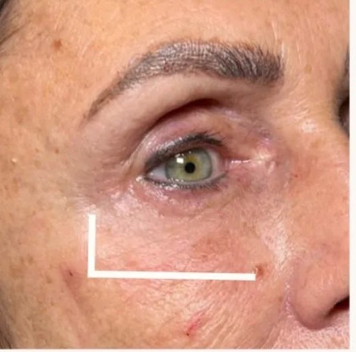 After under-eye filler — tear trough hollowing corrected by Sarah Fuzailov, NP injector