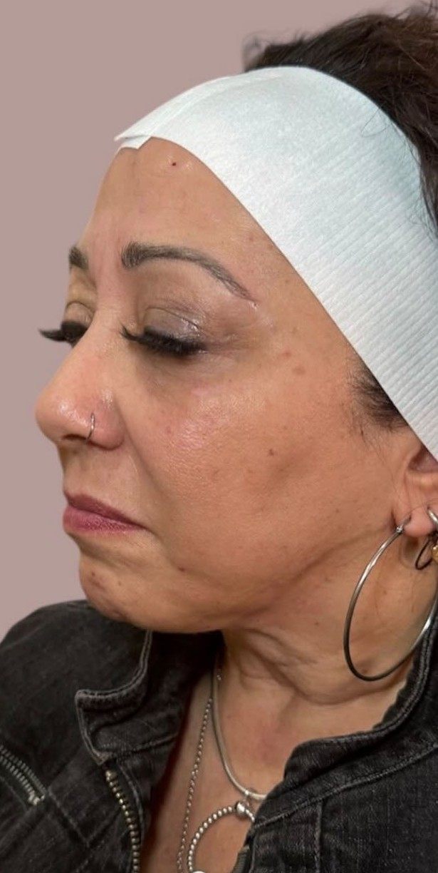 Before full face rejuvenation — side profile prior to injectable treatment at Sarah Aesthetics, New Hyde Park, NY