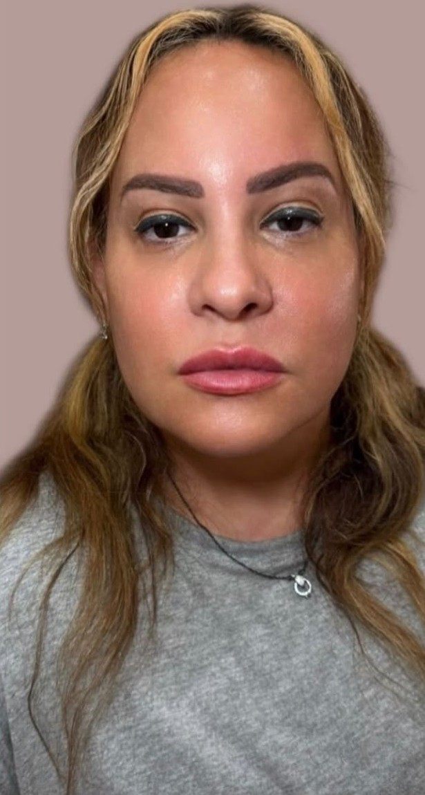 After full face rejuvenation — front view following injectable treatment by Sarah Fuzailov, NP injector
